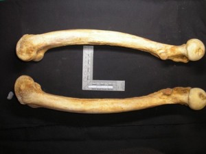 Osteomalacia in the thighs of an adult