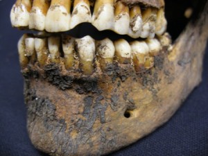 Post 33 (b) Teeth worn away by chewing on clay pipe