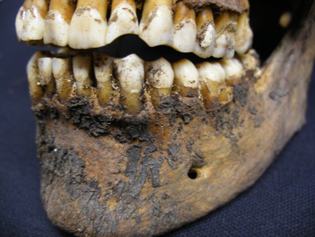 Post-33-b-Teeth-worn-away-by-chewing-on-clay-pipe.jpg