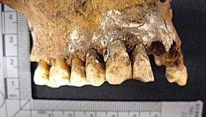 Post 33 (c) Another example of teeth worn by pipe in a younger adult