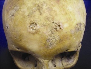 Post 52 Skull showing clear evidence of syphilis